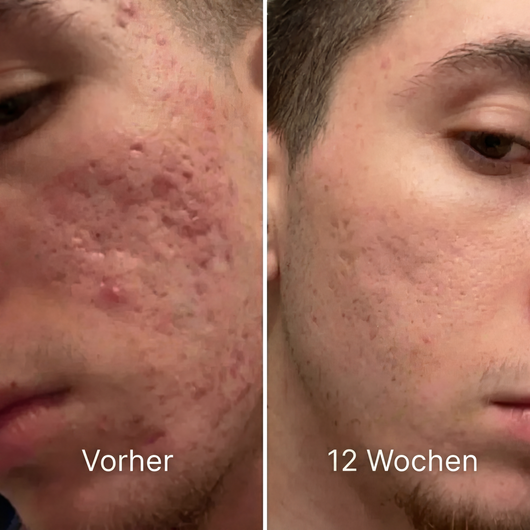 Klinischer Silikonstift zur Reparatur von Narben · Akne & Hautstruktur für Männer